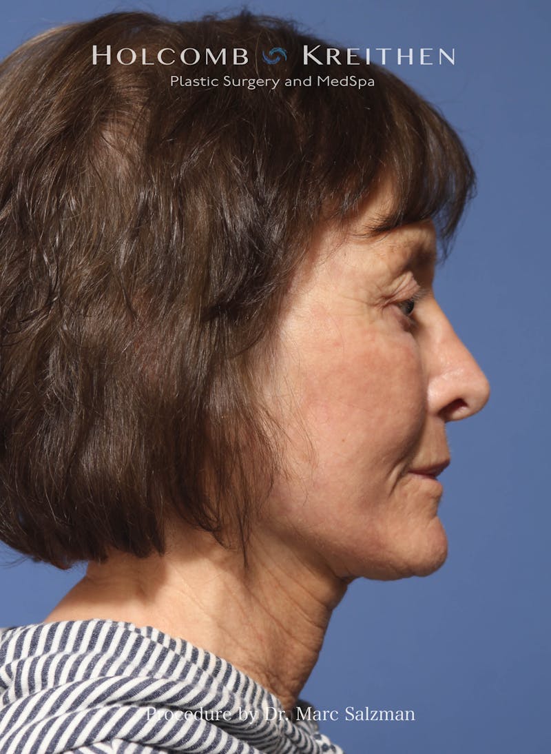 Facelift Before & After Gallery - Patient 212635 - Image 6