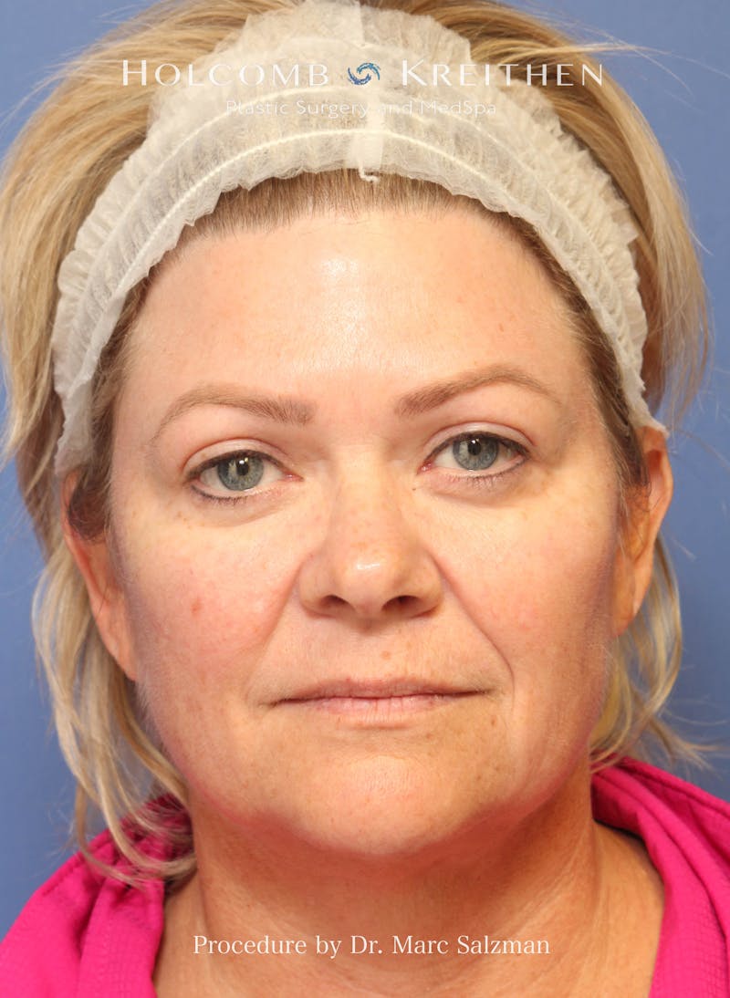 Facelift Before & After Gallery - Patient 138791 - Image 1