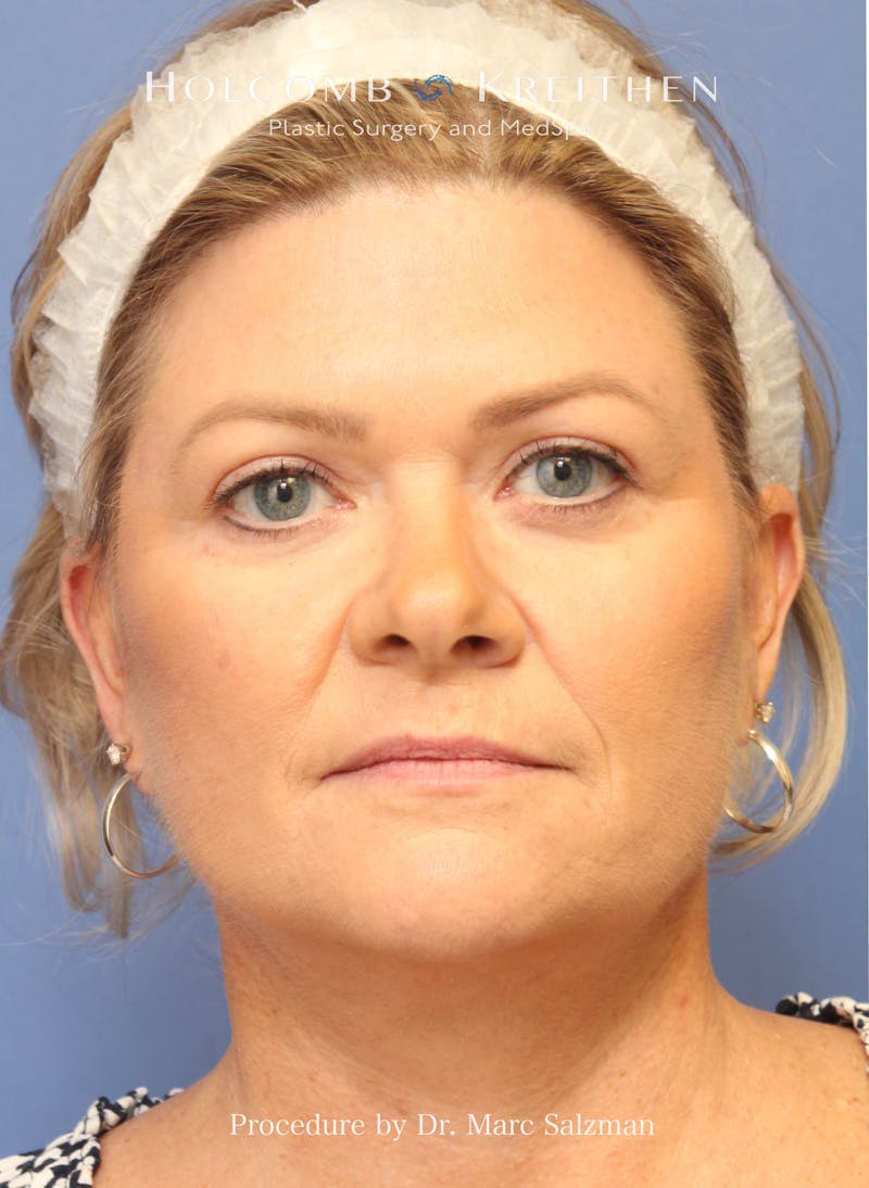 Facelift Before & After Gallery - Patient 138791 - Image 2