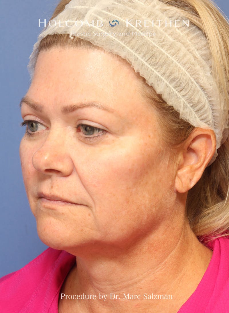 Facelift Before & After Gallery - Patient 138791 - Image 3