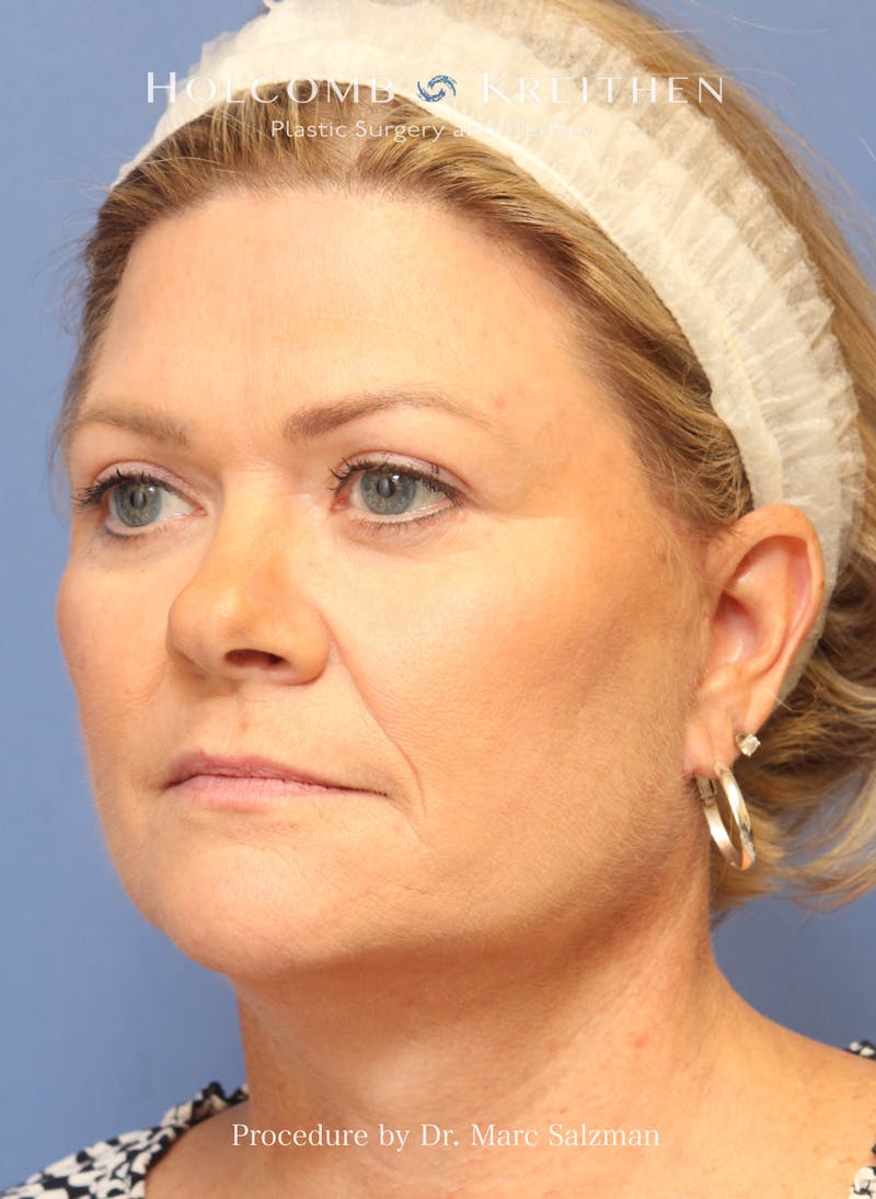 Facelift Before & After Gallery - Patient 138791 - Image 4