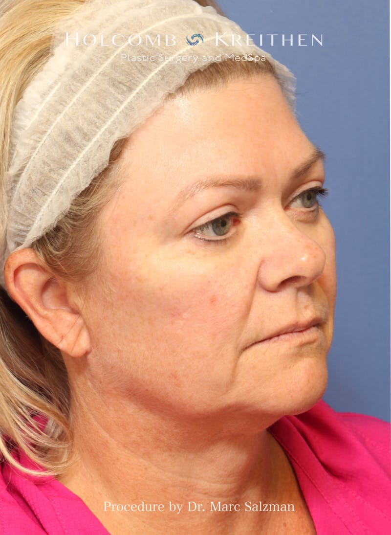 Facelift Before & After Gallery - Patient 138791 - Image 5