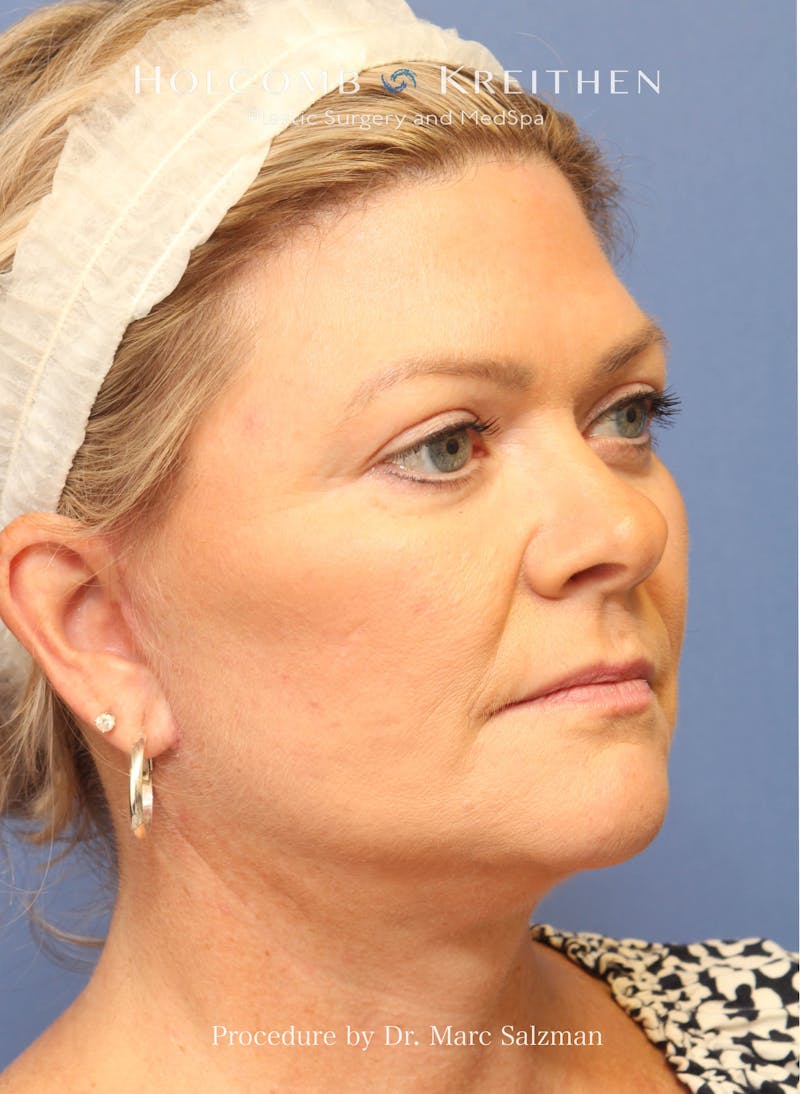 Facelift Before & After Gallery - Patient 138791 - Image 6