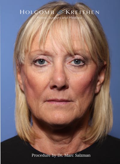 Facelift Before & After Gallery - Patient 172458 - Image 1