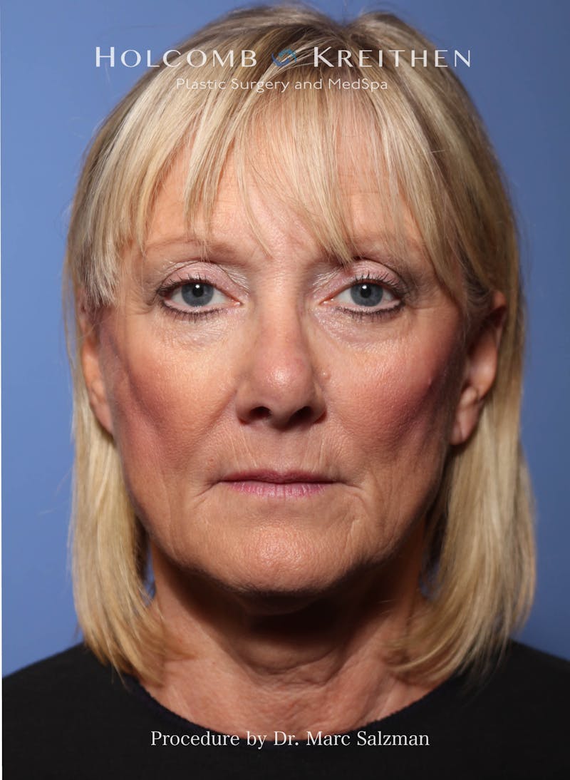 Facelift Before & After Gallery - Patient 172458 - Image 1