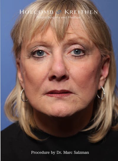 Facelift Before & After Gallery - Patient 172458 - Image 2