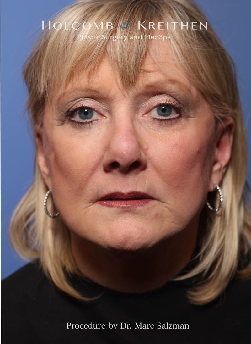 Facelift Before & After Gallery - Patient 172458 - Image 2