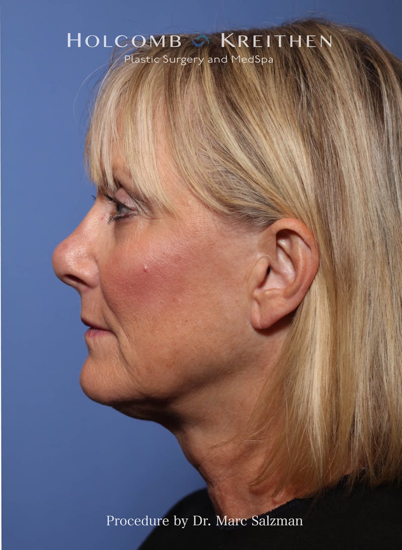 Facelift Before & After Gallery - Patient 172458 - Image 3