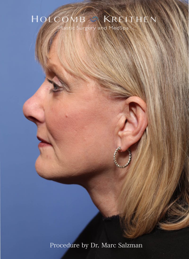 Facelift Before & After Gallery - Patient 172458 - Image 4