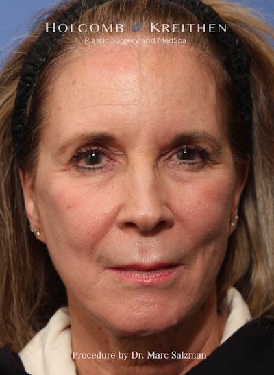 Facelift Before & After Gallery - Patient 348250 - Image 1