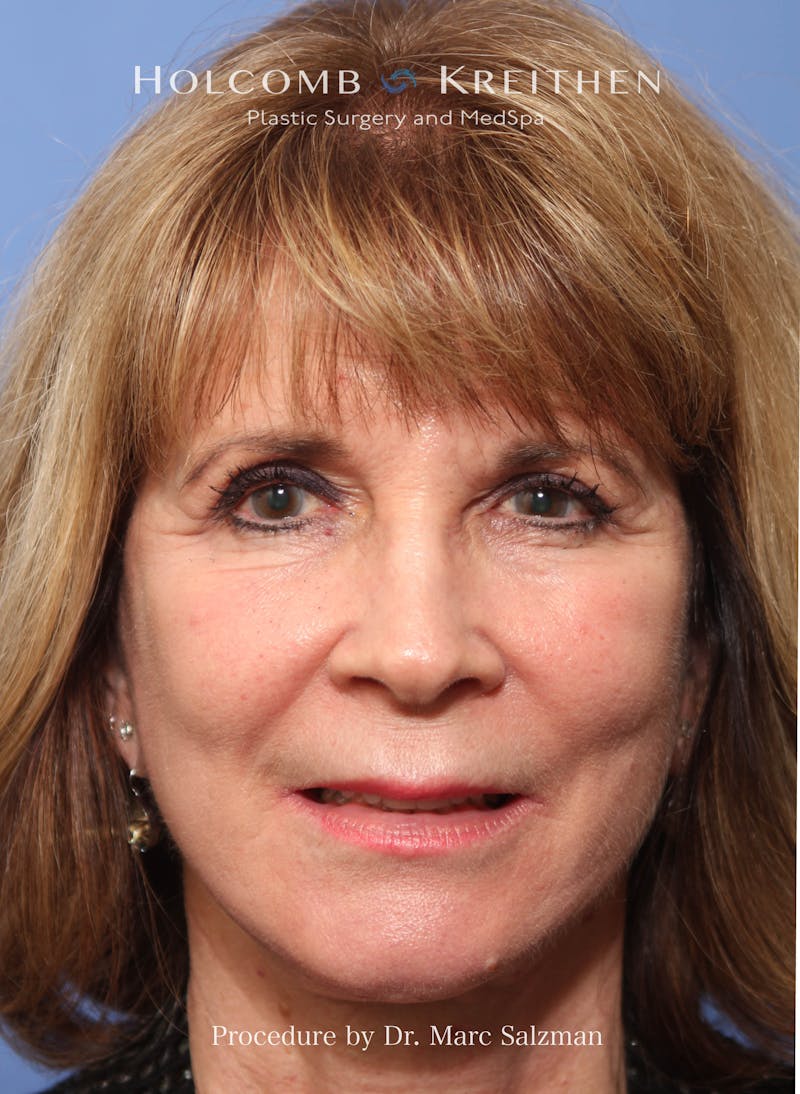 Facelift Before & After Gallery - Patient 348250 - Image 2