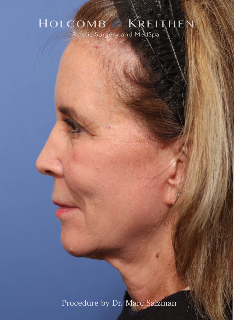 Facelift Before & After Gallery - Patient 348250 - Image 3