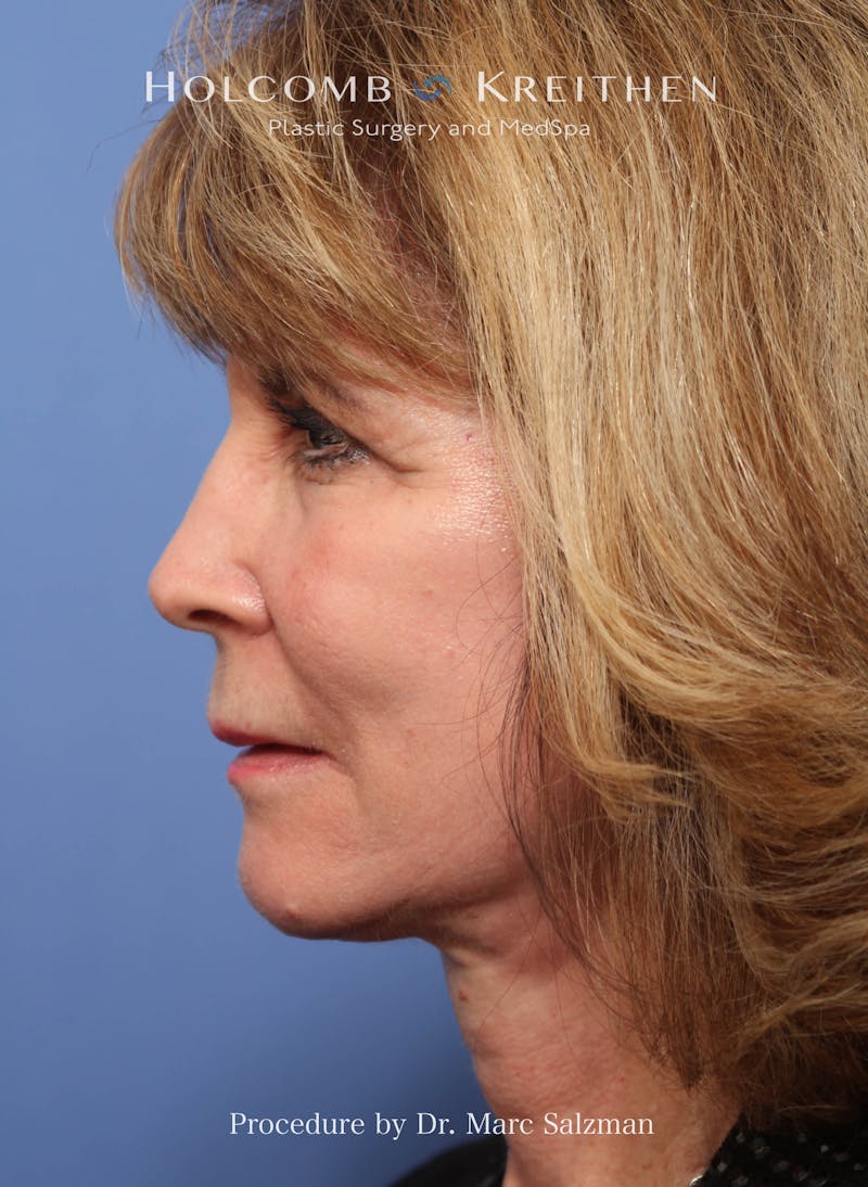 Facelift Before & After Gallery - Patient 348250 - Image 4