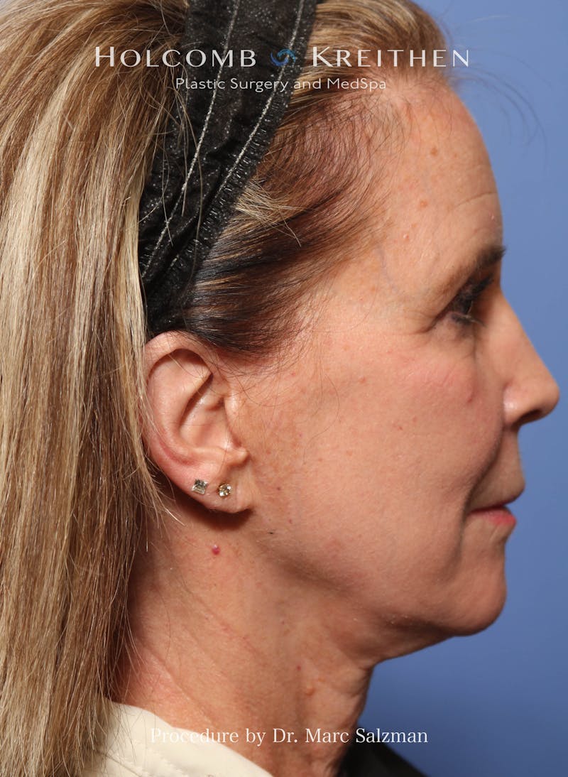 Facelift Before & After Gallery - Patient 348250 - Image 5