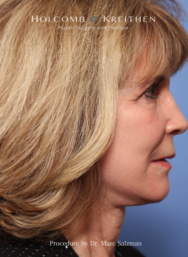 Facelift Before & After Gallery - Patient 348250 - Image 6