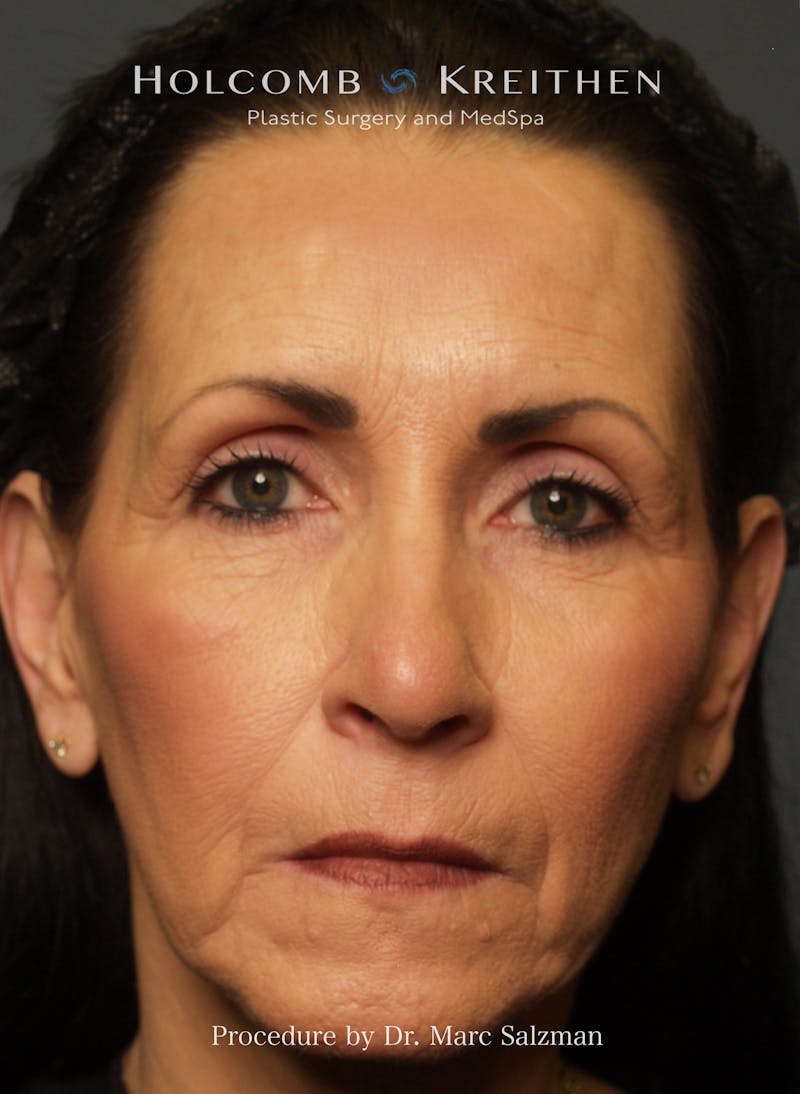 Facelift Before & After Gallery - Patient 804913 - Image 1