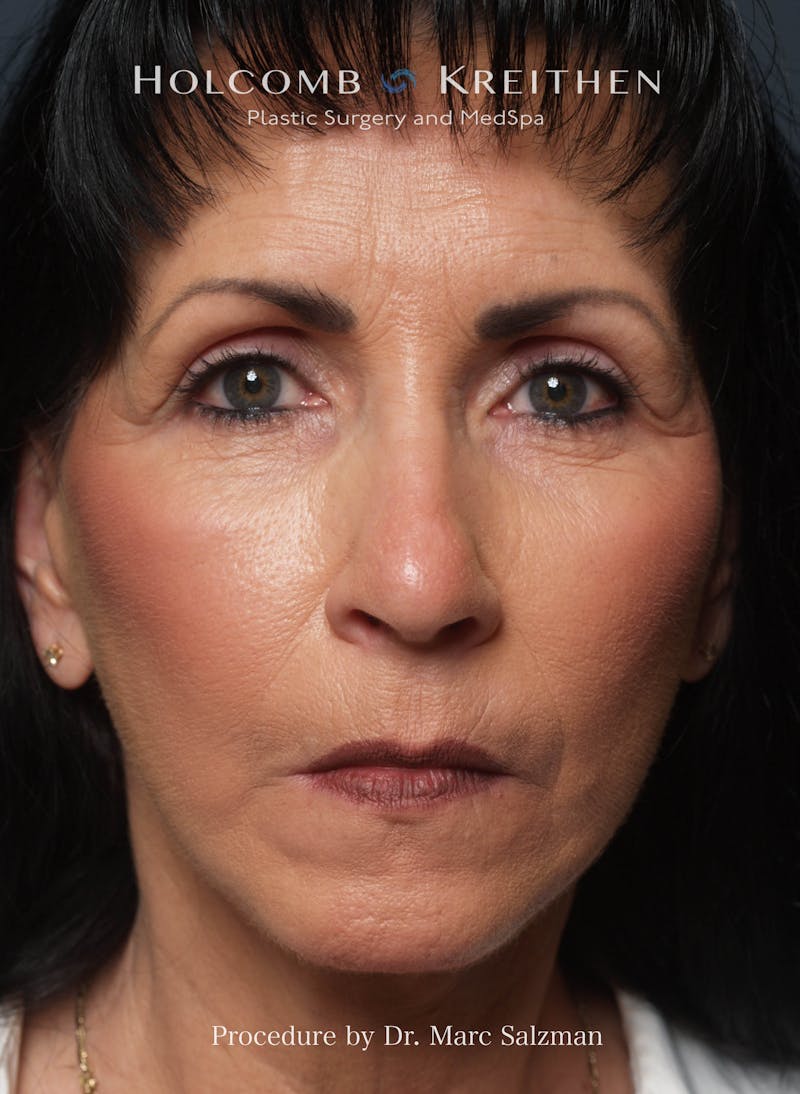 Facelift Before & After Gallery - Patient 804913 - Image 2