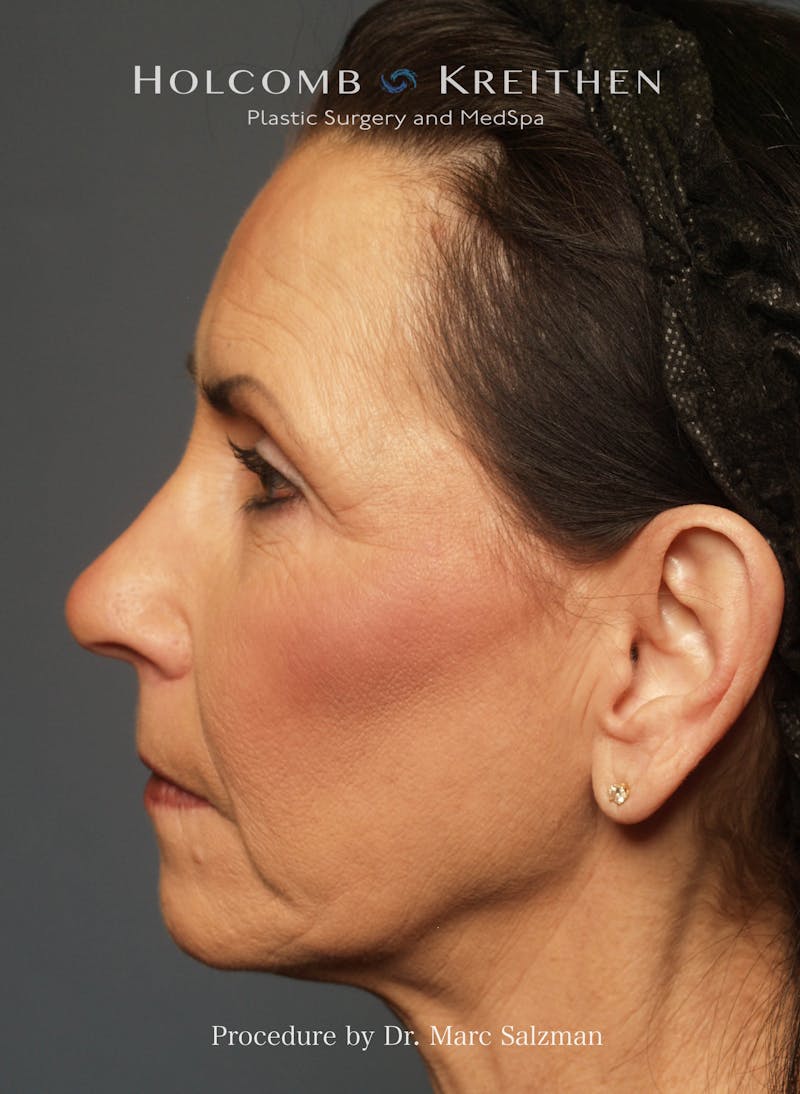 Facelift Before & After Gallery - Patient 804913 - Image 3