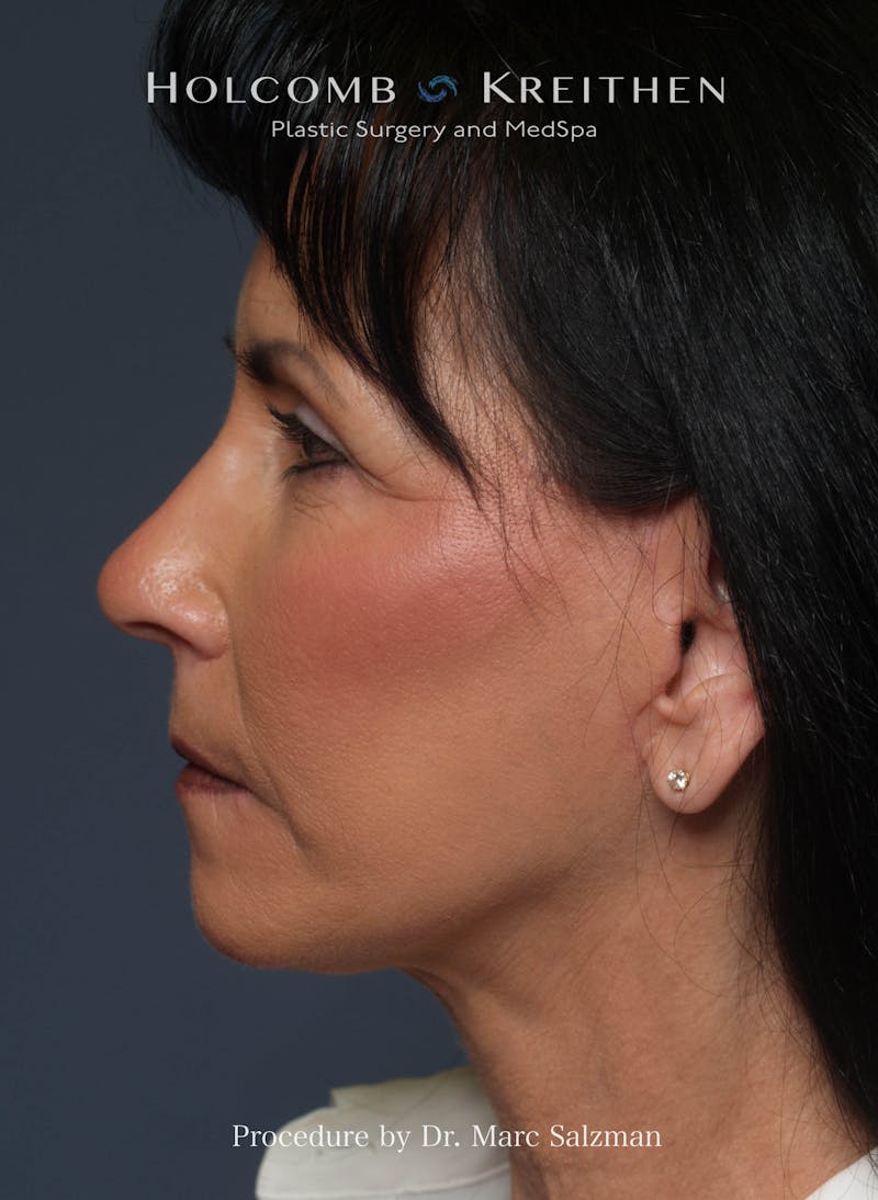 Facelift Before & After Gallery - Patient 804913 - Image 4