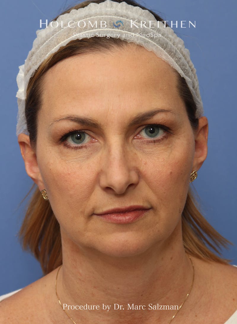 Facelift Before & After Gallery - Patient 410823 - Image 1