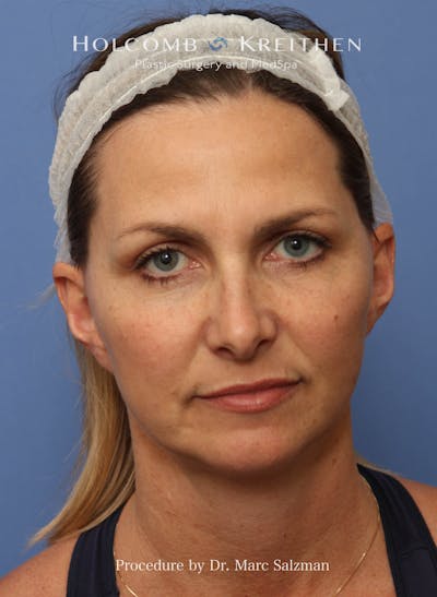 Facelift Before & After Gallery - Patient 410823 - Image 2