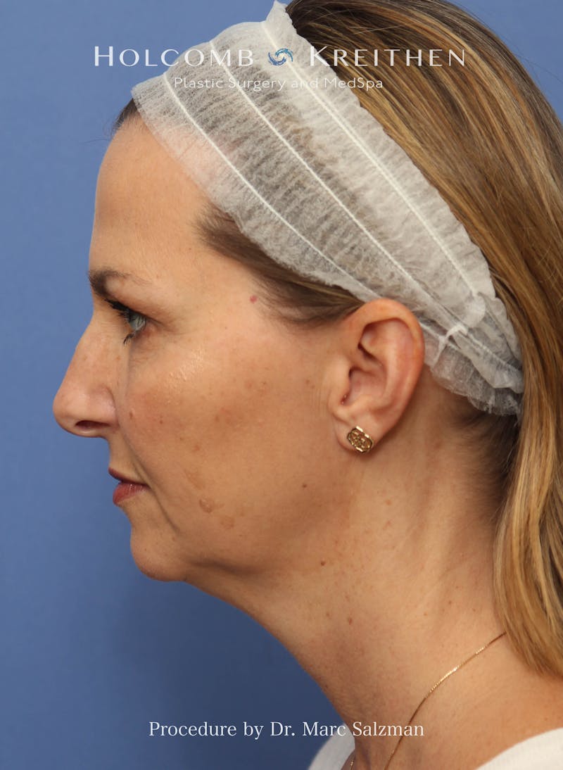 Facelift Before & After Gallery - Patient 410823 - Image 3