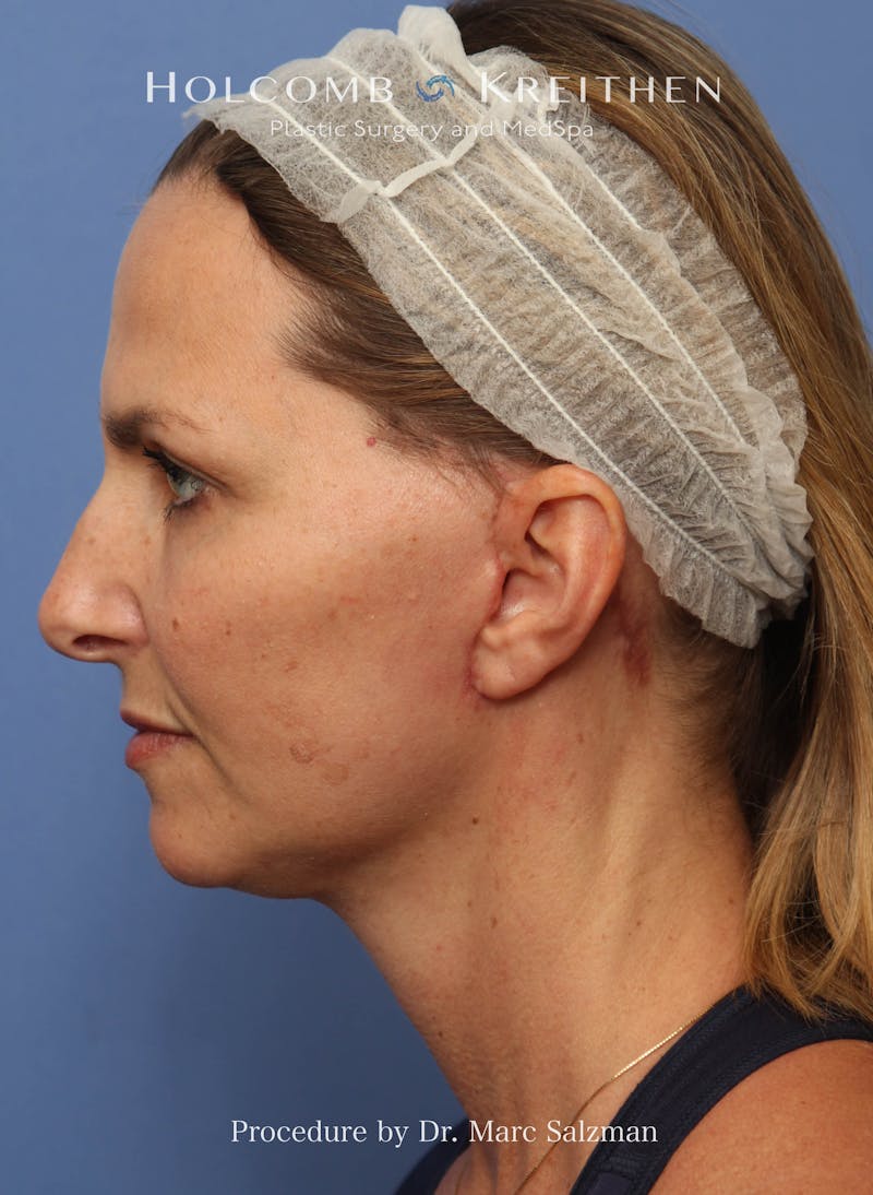 Facelift Before & After Gallery - Patient 410823 - Image 4