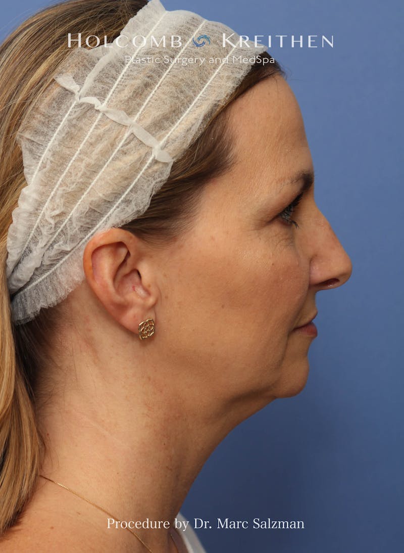 Facelift Before & After Gallery - Patient 410823 - Image 5