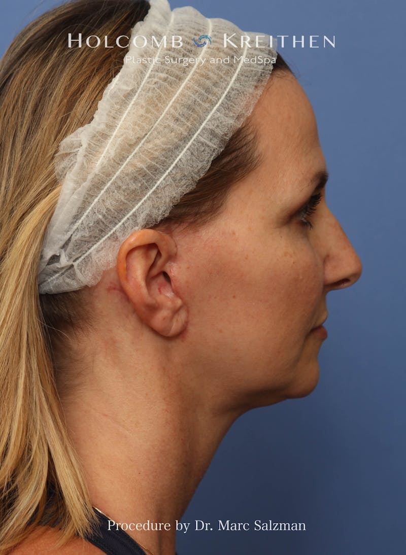 Facelift Before & After Gallery - Patient 410823 - Image 6