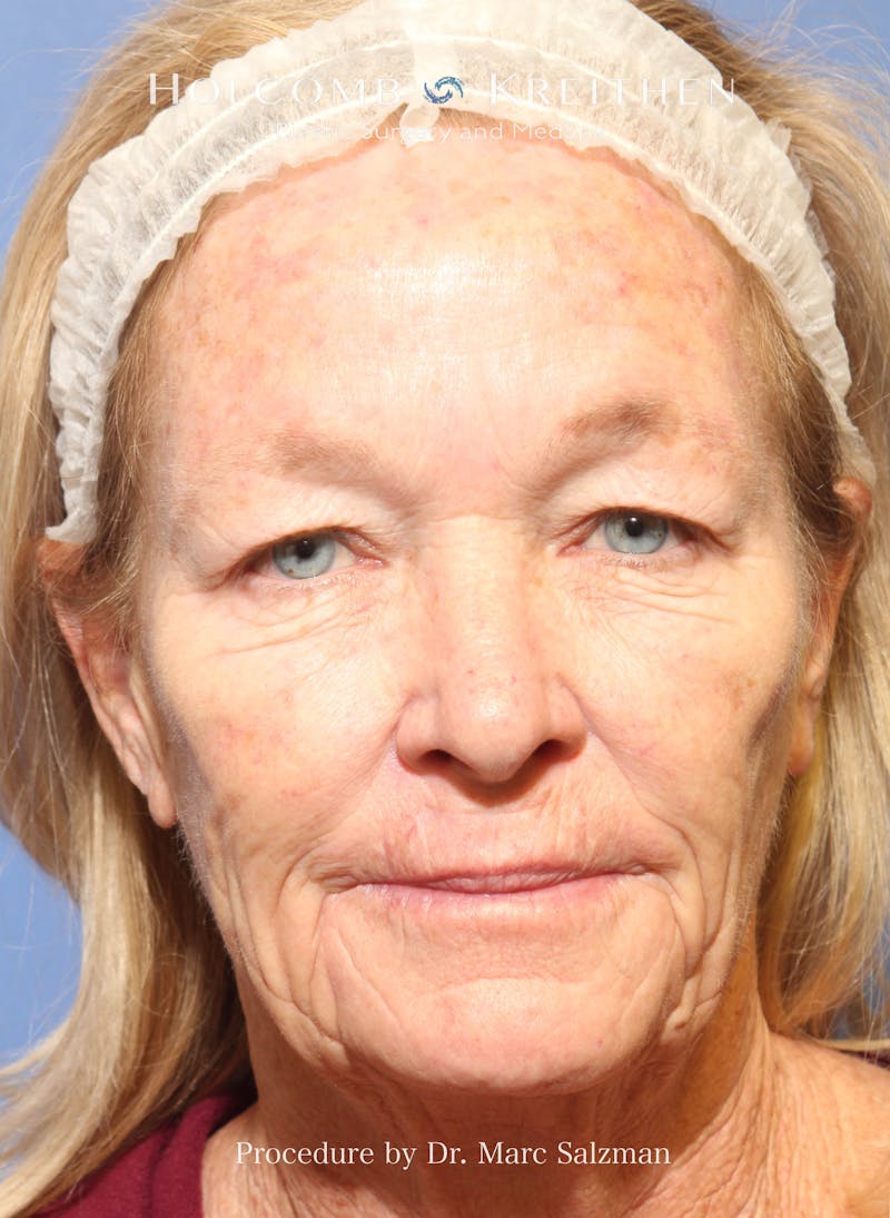 eCO2 Fractional Laser Before & After Gallery - Patient 201710 - Image 1