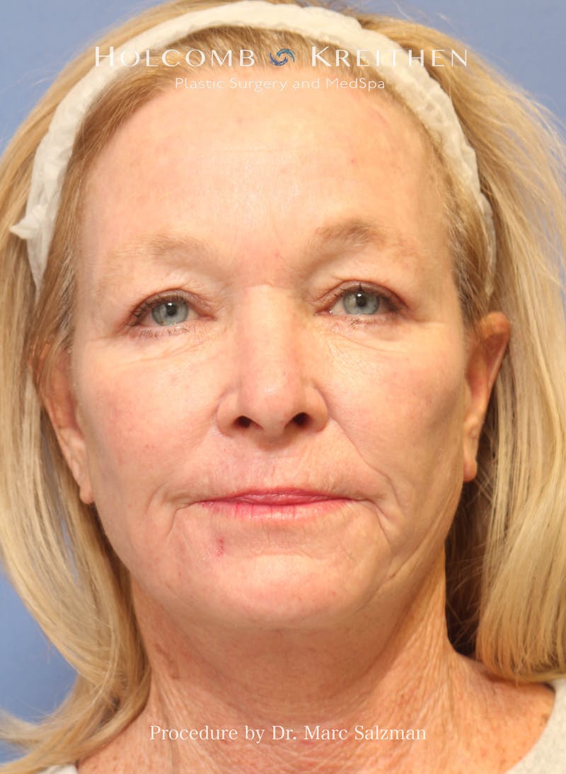 eCO2 Fractional Laser Before & After Gallery - Patient 201710 - Image 2