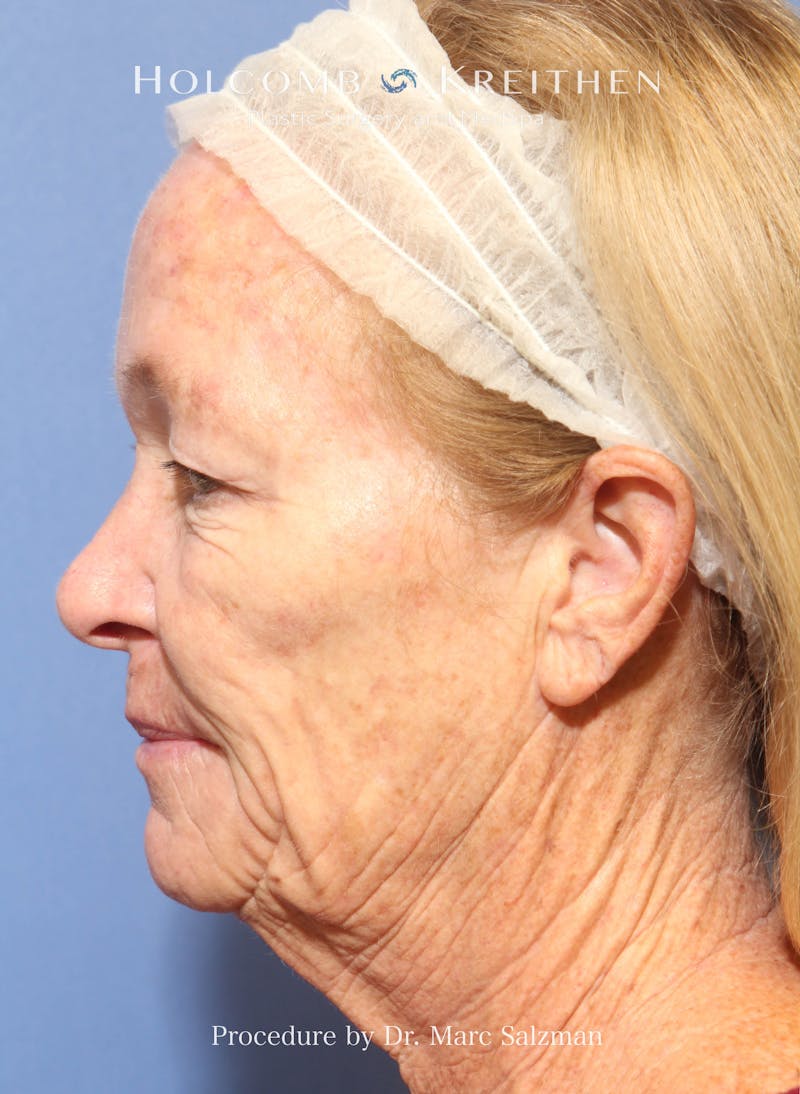 eCO2 Fractional Laser Before & After Gallery - Patient 201710 - Image 3