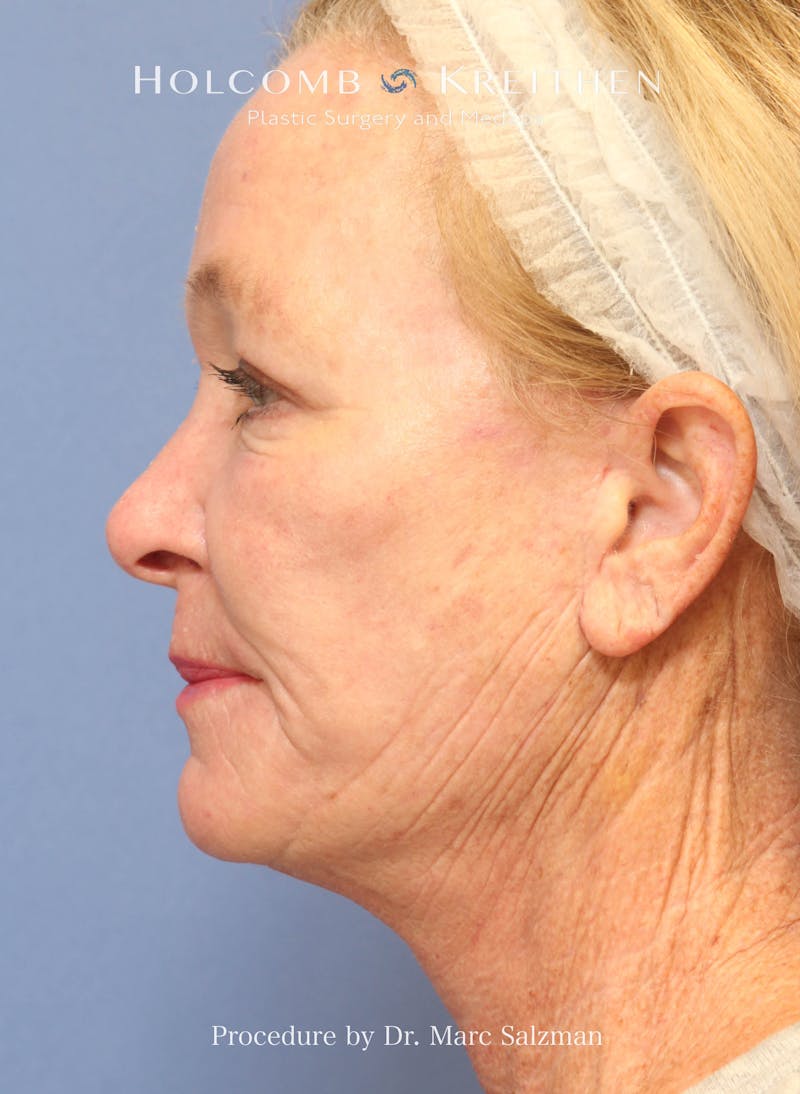 eCO2 Fractional Laser Before & After Gallery - Patient 201710 - Image 4