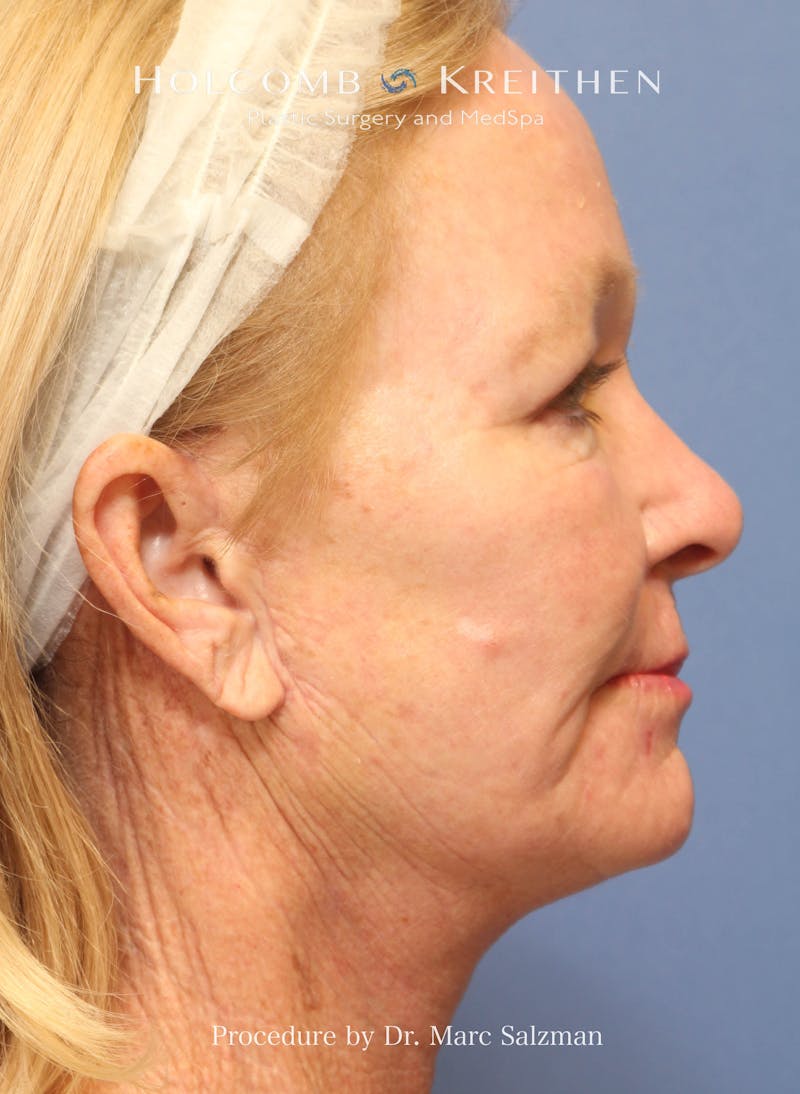 eCO2 Fractional Laser Before & After Gallery - Patient 201710 - Image 6