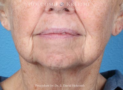 Facial Implants Before & After Gallery - Patient 164717 - Image 1