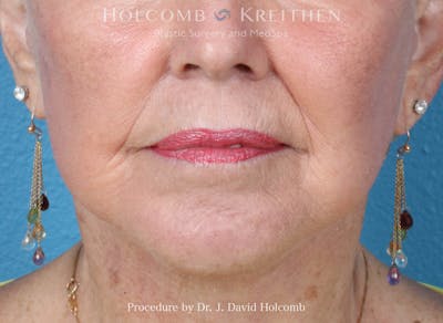 Facial Implants Before & After Gallery - Patient 164717 - Image 2
