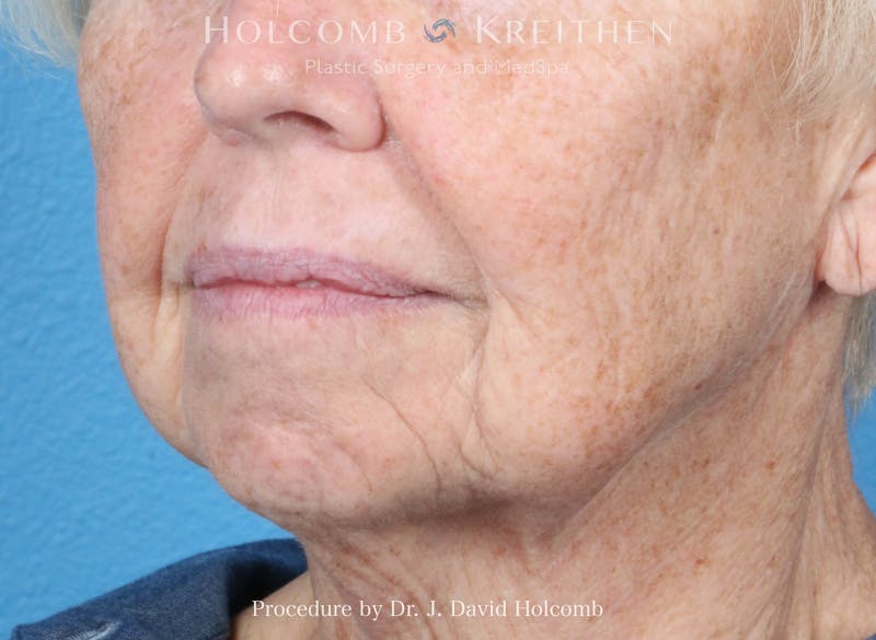 Facial Implants Before & After Gallery - Patient 164717 - Image 3