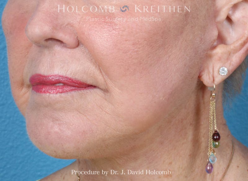 Facial Implants Before & After Gallery - Patient 164717 - Image 4