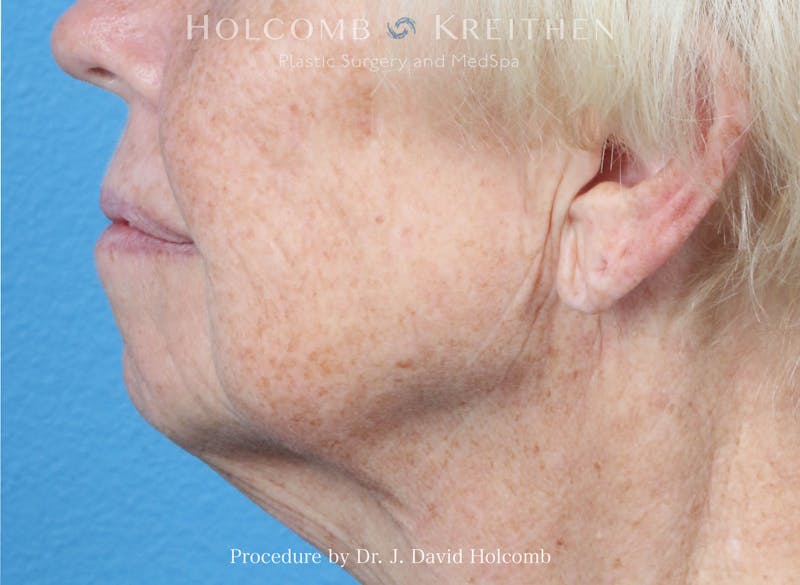 Facial Implants Before & After Gallery - Patient 164717 - Image 5