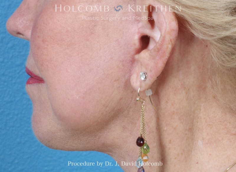 Facial Implants Before & After Gallery - Patient 164717 - Image 6