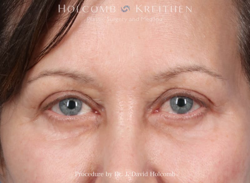 eCO2 Fractional Laser Before & After Gallery - Patient 340734 - Image 1