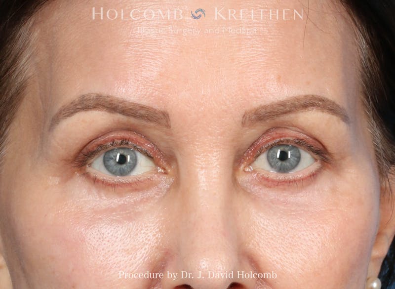 eCO2 Fractional Laser Before & After Gallery - Patient 340734 - Image 2