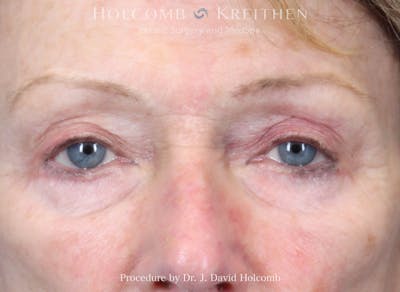 eCO2 Fractional Laser Before & After Gallery - Patient 156749 - Image 1