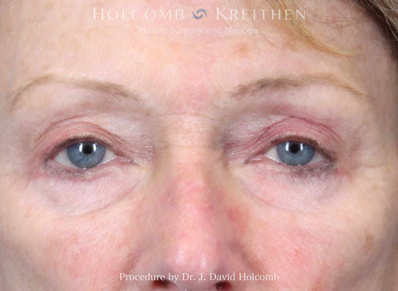 eCO2 Fractional Laser Before & After Gallery - Patient 156749 - Image 1
