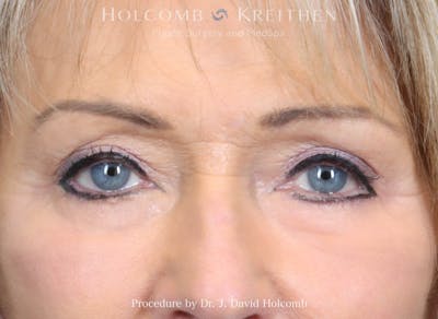 eCO2 Fractional Laser Before & After Gallery - Patient 156749 - Image 2