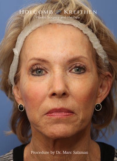 eCO2 Fractional Laser Before & After Gallery - Patient 286276 - Image 1