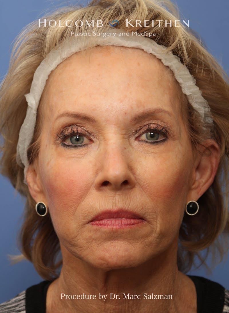 eCO2 Fractional Laser Before & After Gallery - Patient 286276 - Image 1