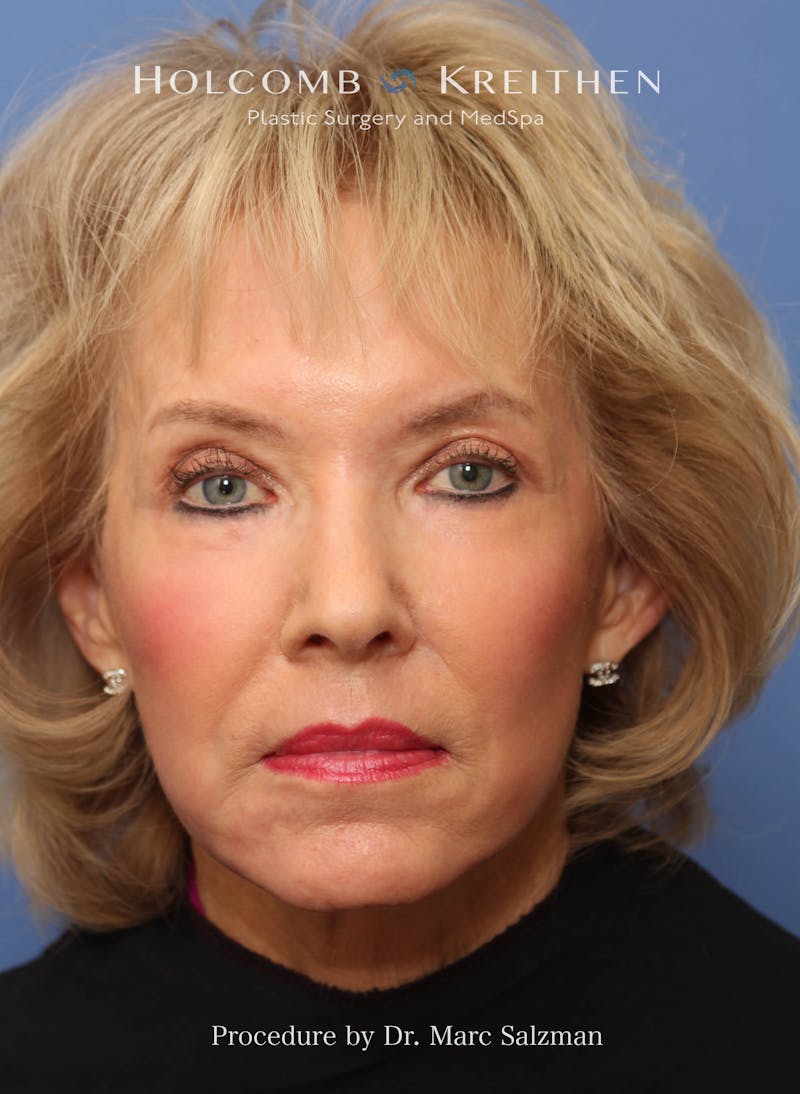 eCO2 Fractional Laser Before & After Gallery - Patient 286276 - Image 2