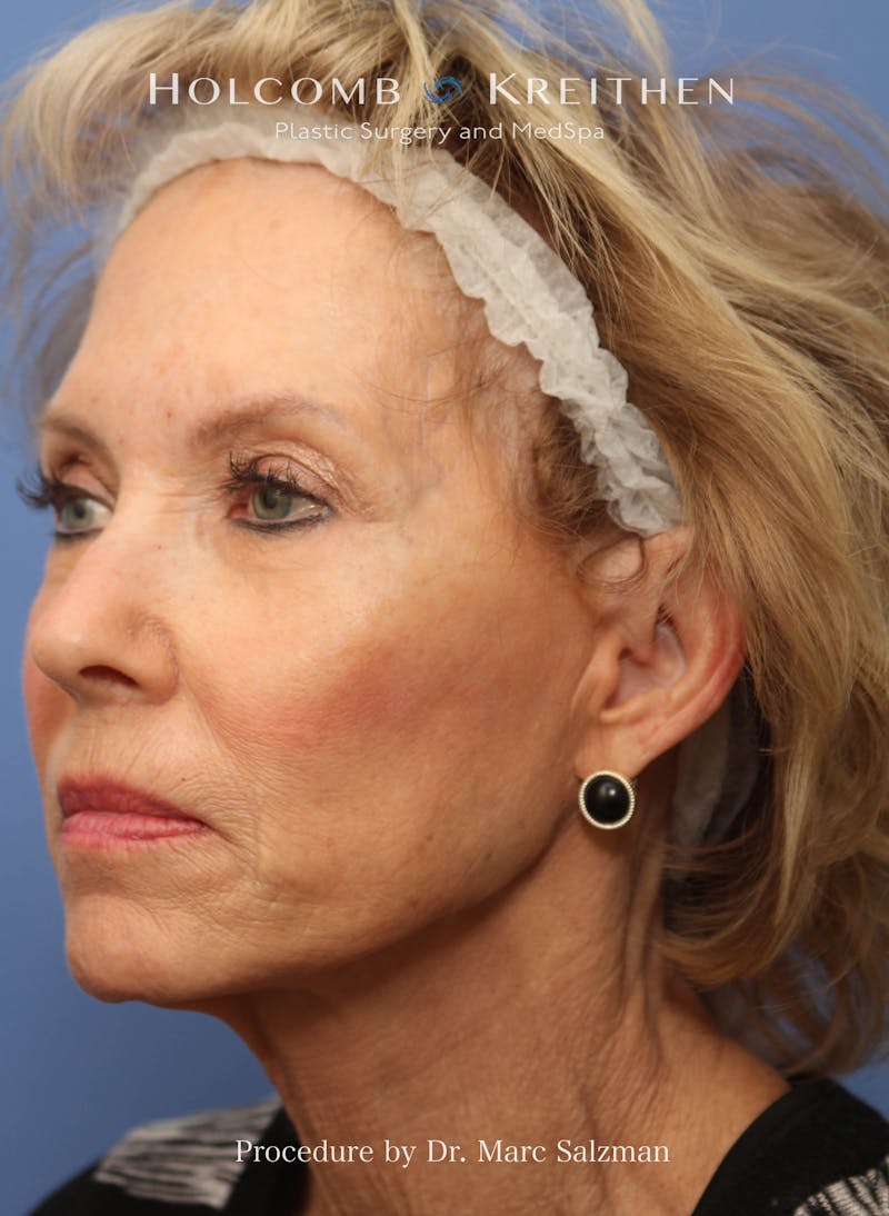 eCO2 Fractional Laser Before & After Gallery - Patient 286276 - Image 3