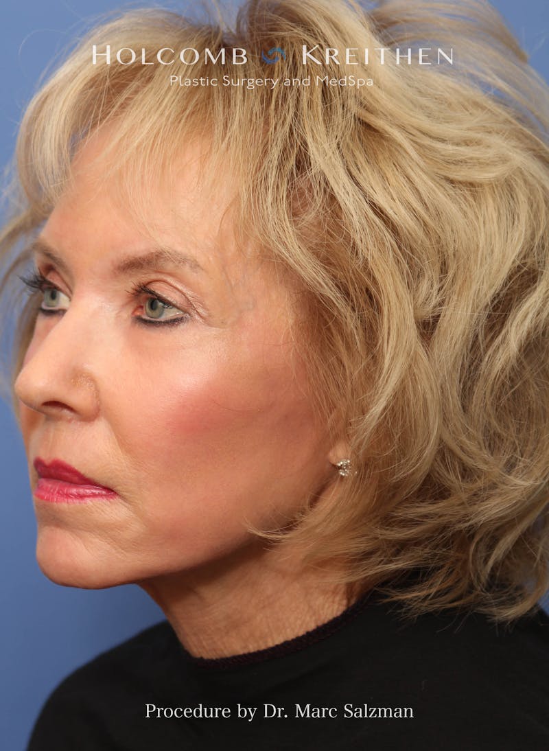 eCO2 Fractional Laser Before & After Gallery - Patient 286276 - Image 4